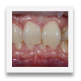 Frontzähne_Wieland Dental-Technik